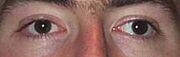 Strabismus